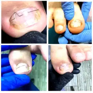 correction_light_full Корекція врослого нігтя (скоби, пластини) Встановлення коригуючих систем (скоби, пластини) для безпечного виправлення деформацій без дискомфорту.