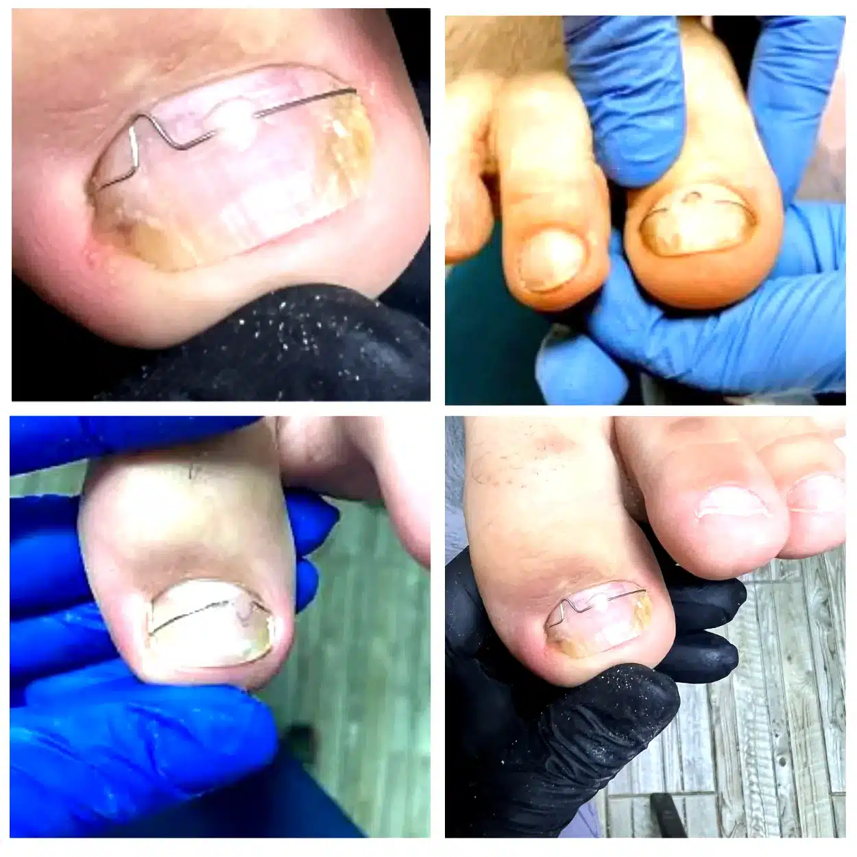 correction_light_full Корекція врослого нігтя (скоби, пластини) Встановлення коригуючих систем (скоби, пластини) для безпечного виправлення деформацій без дискомфорту.