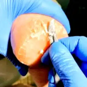 heel_corrected_full Видалення огрубілої шкіри та тріщин на п'ятах Харків Салтівка