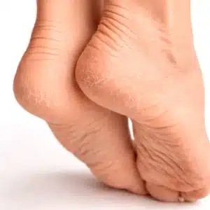 heels_cracks_optimized Догляд за стопами Харків