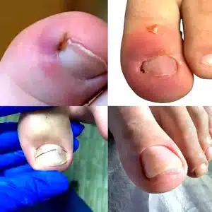ingrown_nail_collage_optimized Врослий ніготь професійний підхідДелікатна обробка та корекція,