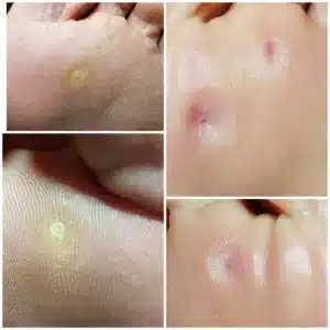 photo_2025-12-17_23-13-11 Професійна обробка мозолів і натоптишів PodoExpert Харків