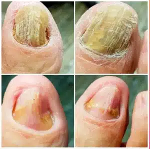 photo_2025-12-17_23-13-17(1) Апаратний догляд за ураженими нігтями результат роботи подолога Харків